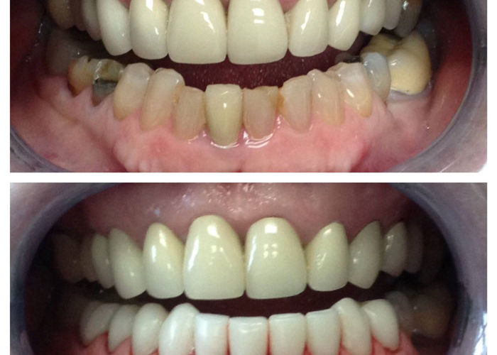 Porcelain Veneers Cost Near Me | Stuart Palm City FL