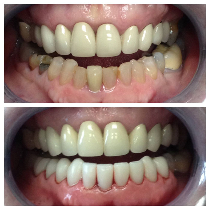 Porcelain Veneers Cost Near Me | Stuart Palm City FL