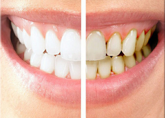 Porcelain Veneers Stuart Palm City Martin County FL