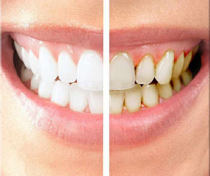 Porcelain Veneers Stuart Palm City Martin County FL