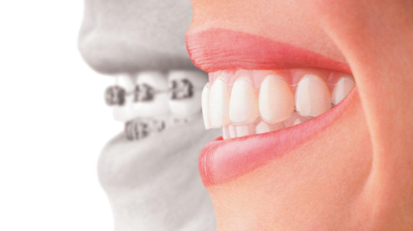Palm City Invisalign vs. Braces