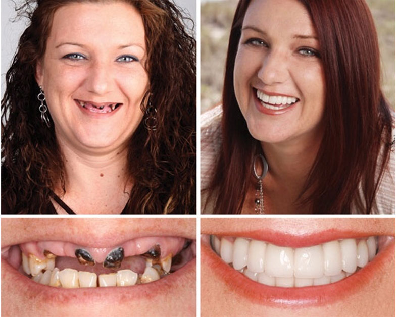 Teeth In A Day Palm City FL