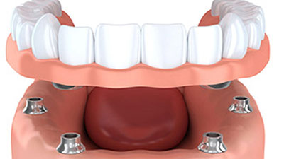 Teeth In A Day Prosthetic